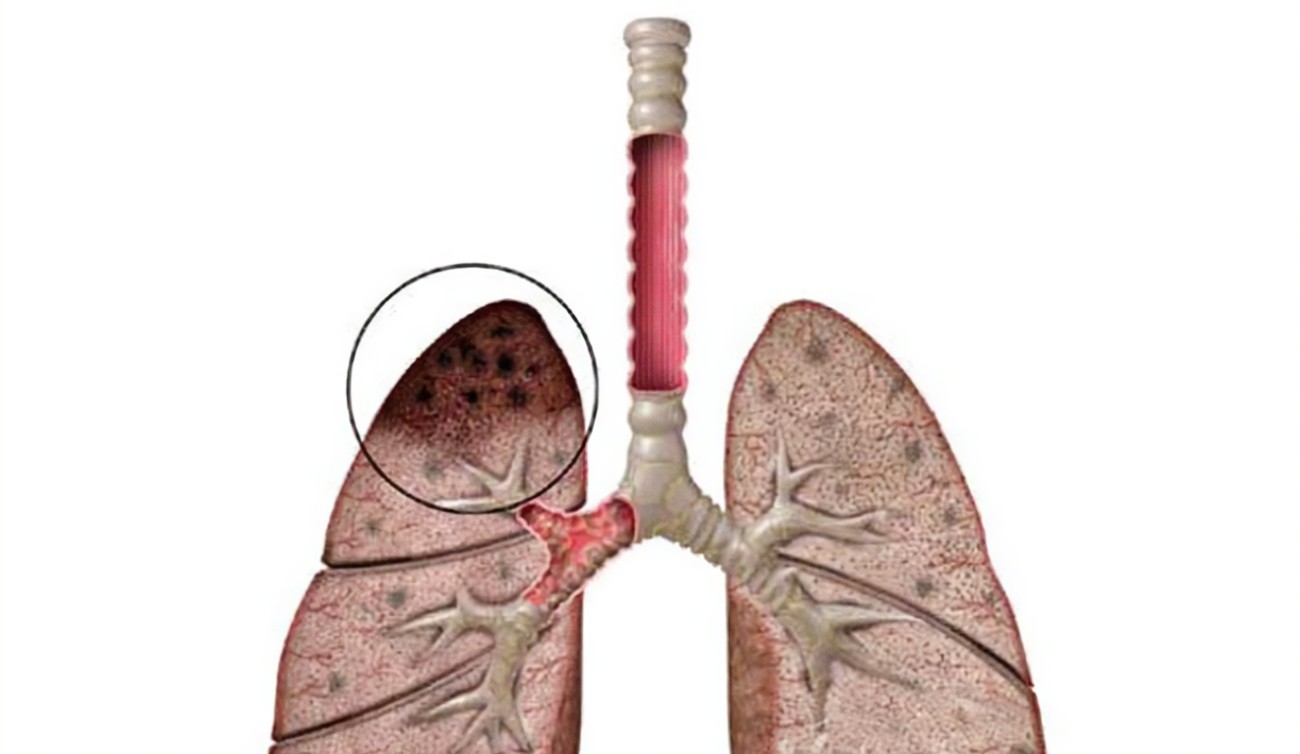 肺結核篩查做什么檢查？